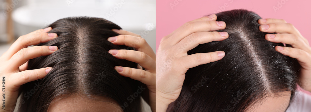Naklejka premium Woman showing hair before and after dandruff treatment on color backgrounds, collage