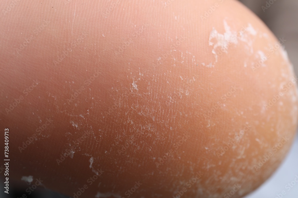 Fototapeta premium Woman with dry skin on foot, closeup