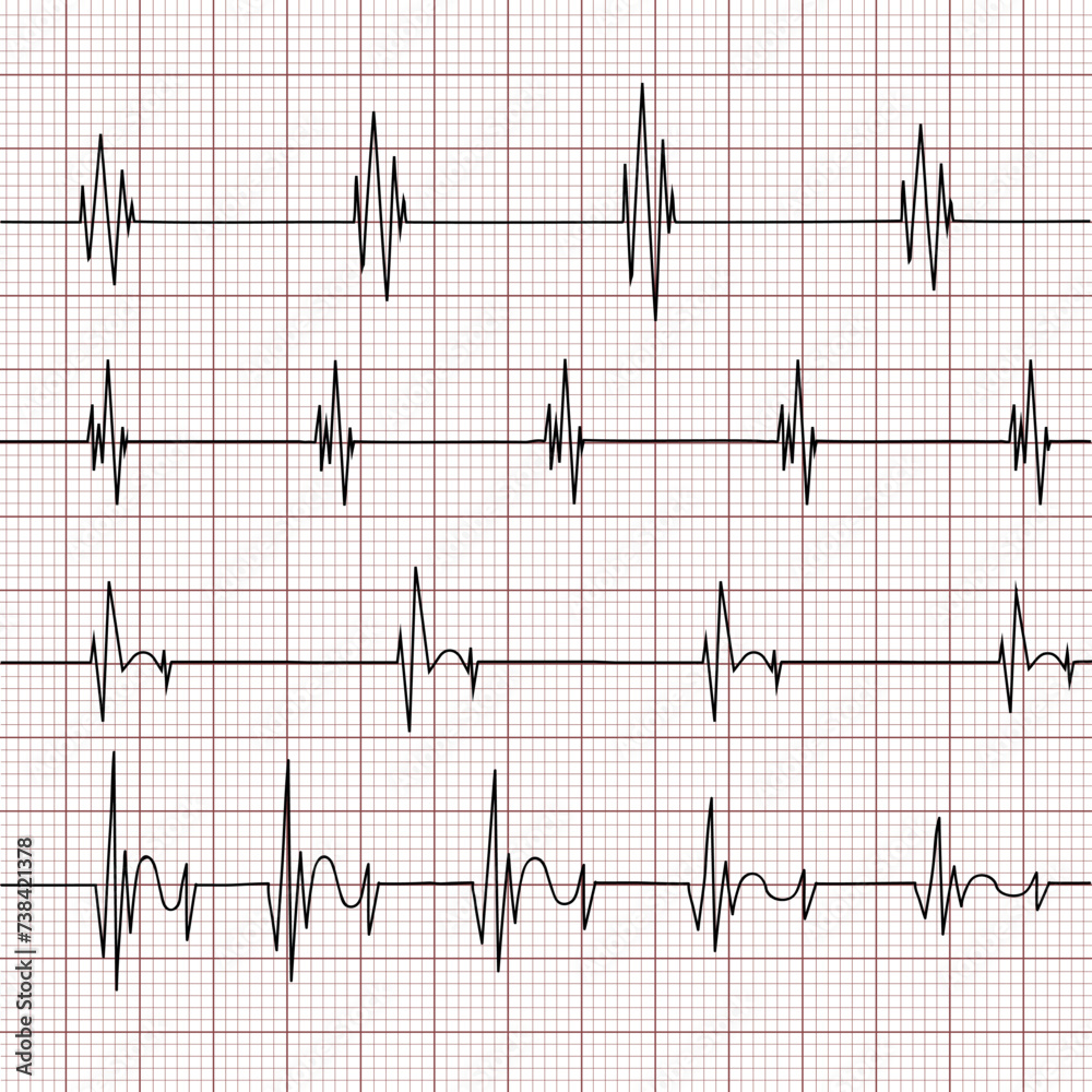 Multiple EKG (Electrocardiogram) graphs on a grid background. Various ...