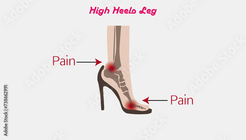 high heels, Symptom pain on foot because wearing high heels make heel bone damage and muscles, Deformation of the foot bones,high heeled shoes structure vertebral column diagram hand drawn schematic