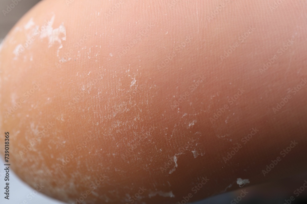 Fototapeta premium Woman with dry skin on foot, closeup