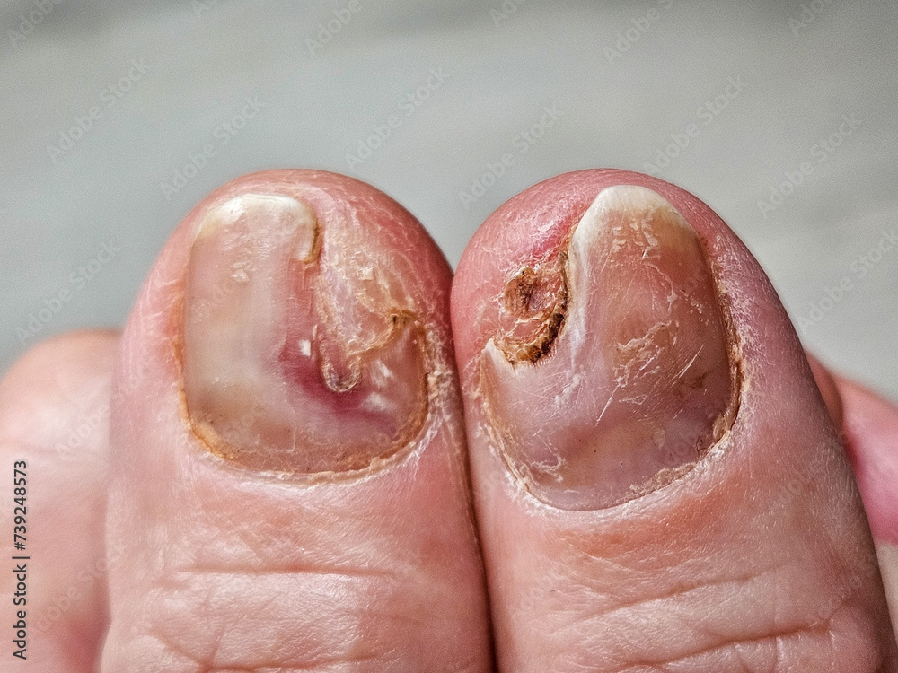Hands and fingers with psoriatic onychodystrophy or psoriatic nails. fungal infection of nails. Deformed human nails. Damaged yellow human nail. Burn to the nail plate after a poor-quality manicure Hands and fingers with psoriatic onychodystrophy or psoriatic nails. fungal infection of nails. Deformed human nails. Damaged yellow human nail. Burn to the nail plate after a poor-quality manicure