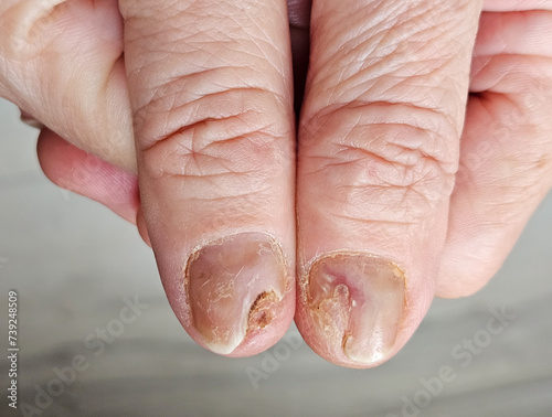 Hands and fingers with psoriatic onychodystrophy or psoriatic nails. fungal infection of nails. Deformed human nails. Damaged yellow human nail. Burn to the nail plate after a poor-quality manicure