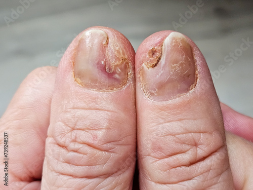 Hands and fingers with psoriatic onychodystrophy or psoriatic nails. fungal infection of nails. Deformed human nails. Damaged yellow human nail. Burn to the nail plate after a poor-quality manicure