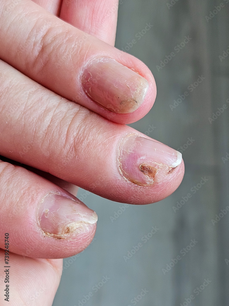 Hands and fingers with psoriatic onychodystrophy or psoriatic nails. fungal infection of nails. Deformed human nails. Damaged yellow human nail. Burn to the nail plate after a poor-quality manicure Hands and fingers with psoriatic onychodystrophy or psoriatic nails. fungal infection of nails. Deformed human nails. Damaged yellow human nail. Burn to the nail plate after a poor-quality manicure