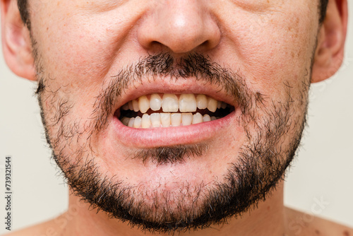 Closeup young man with beautiful smile. Teeth whitening  teeth straightening  fresh breath