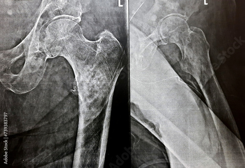 2 view xray with high probability of subtrochanteric, trochanteric fissure fracture, and malignancy metastasis in medial side of the femur shaft below the head, of an old patient with prostate cancer photo