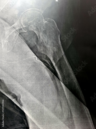 Plain x-ray with high probability of subtrochanteric, trochanteric fissure fracture, and malignancy metastasis in medial side of the femur shaft below the head, of an old patient with prostate cancer photo