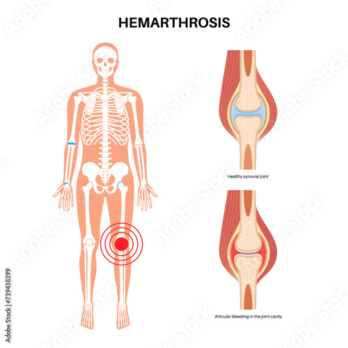 Hemarthrosis in the synovial joint