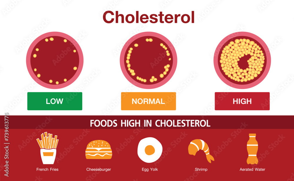 Cholesterol in artery, health risk , vector design, foods high in cholesterol