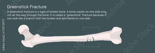 Types of bone fracture. Structure of a bone vector illustration. The quality or structure changes in marrow density. Build and strength of bone tissues. Stymptoms and stages and  growth. Bone anatomy.