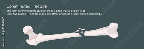 Types of bone fracture. Structure of a bone vector illustration. The quality or structure changes in marrow density. Build and strength of bone tissues. Stymptoms and stages and  growth. Bone anatomy.