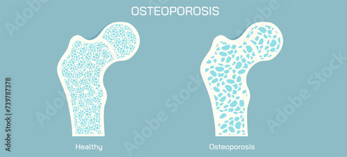 Bone density measurements and stages of osteoporosis. A bone disease that develops when bone mineral density and bone mass decreases, or the quality or structure  changes. vector illustration. photo