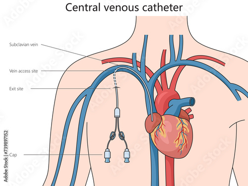 Central venous catheter structure diagram hand drawn schematic raster illustration. Medical science educational illustration