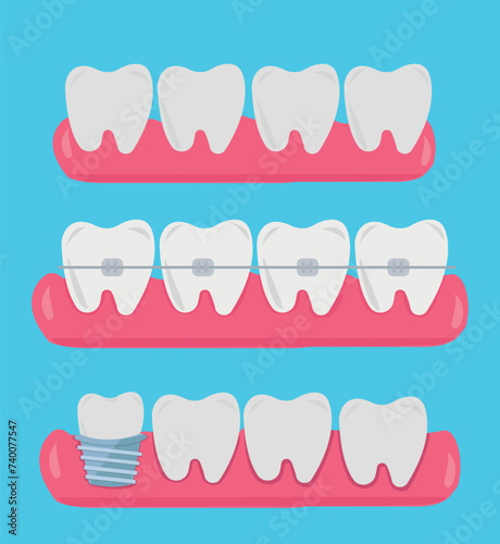 Tooth, teeth, implant, dental vector illustration set