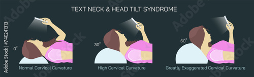 Text Neck Syndrome of phone posture is the onset of cervical spinal degeneration from excess look down at mobile screens. Aka Anterior head prevention. Cervical neck aches vector illustration. 