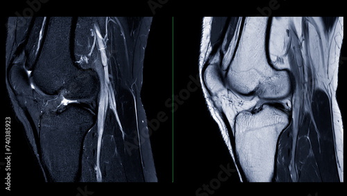 Magnetic resonance imaging or MRI of  knee joint. This diagnostic technique is crucial for assessing ligaments, cartilage, and identifying issues like tears or inflammation.