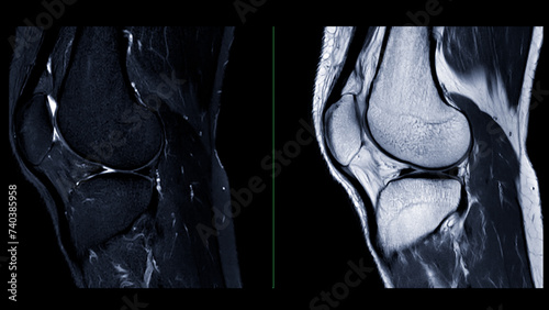 Magnetic resonance imaging or MRI of  knee joint. This diagnostic technique is crucial for assessing ligaments, cartilage, and identifying issues like tears or inflammation. photo