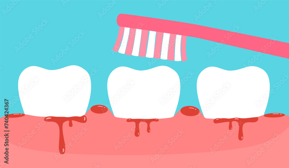 Brushing teeth with bleeding on gum vector illustration. Gingivitis. Periodontitis or gum disease concept. Brushing teeth with bleeding on gum vector illustration. Gingivitis. Periodontitis or gum disease concept.