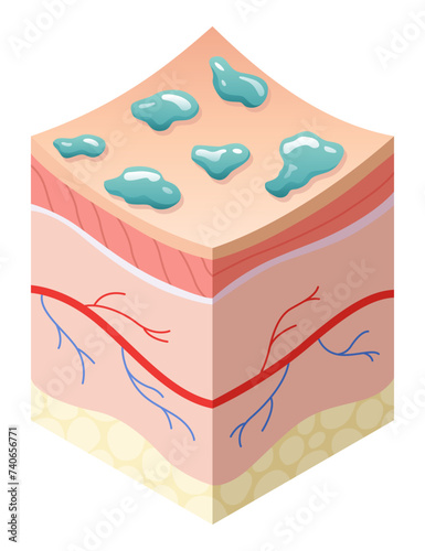 Skincare medical concept. Problems in cross-section of human skin horizontal layers structure. Anatomy illustrative model unhealthy layer of skin
