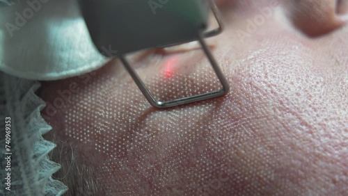 Extreme close up shot of Beautician cosmetologist doing procedure fractional microneedle mesotherapy rejuvenation with laser technology. Hardware cosmetology in clinic salon for client.
