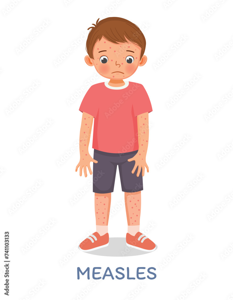 Cute little boy suffering from measles rash allergy skin Cute little boy suffering from measles rash allergy skin