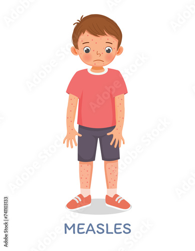 Cute little boy suffering from measles rash allergy skin 