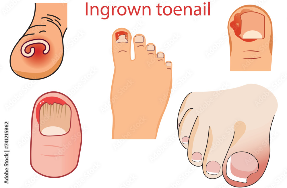 Grafika wektorowa Stock: Ingrown toenail,pain if pressure is placed on ...