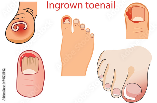 Ingrown toenail,pain if pressure is placed on the toe,inflammation of the skin at the end of the toe,a buildup of fluid surrounding the toe,overgrowth of skin around the affected toe,vectors