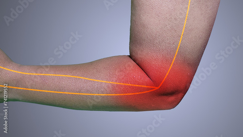 Cubital tunnel syndrome medical concept
 photo