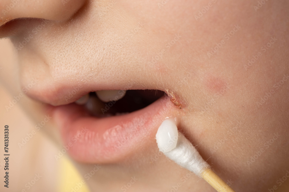 Naklejka premium Treatment with ointment for a dermatological disease in the corners of the mouth and lips of a little girl. Treatment of seizures, herpes and angular stomatitis, slit-like impetigo, close-up