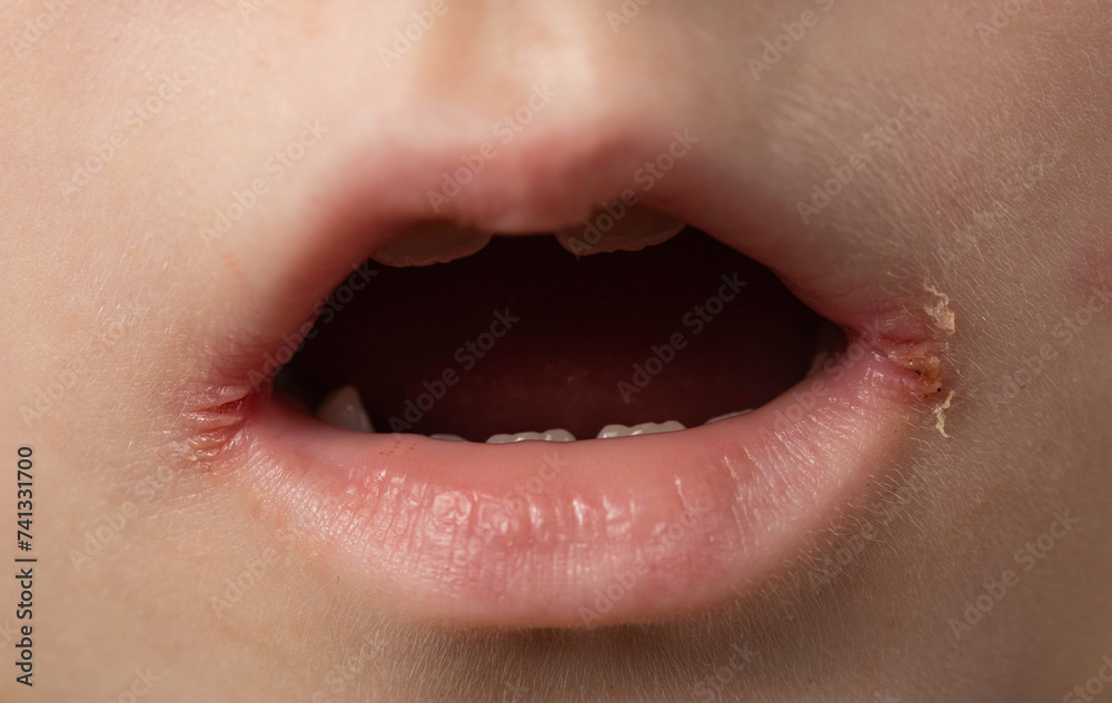 slitlike impetigo in a little girl in the corners of her mouth. Skin