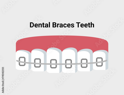 Dental braces teeth flat illustration. Dentistry and orthodontics vector illustration. Dental clinic services, stomatology, dentistry, orthodontics, oral health care and hygiene vector.