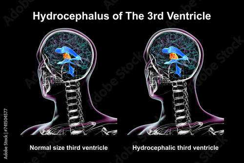 Enlargement of the third brain ventricle, 3D illustration photo