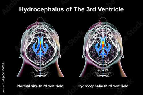 Enlargement of the third brain ventricle, 3D illustration photo