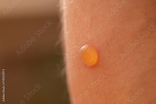Macro of a small round blister on a skin after burn. Male leg, many tiny hairs, scald close up photo