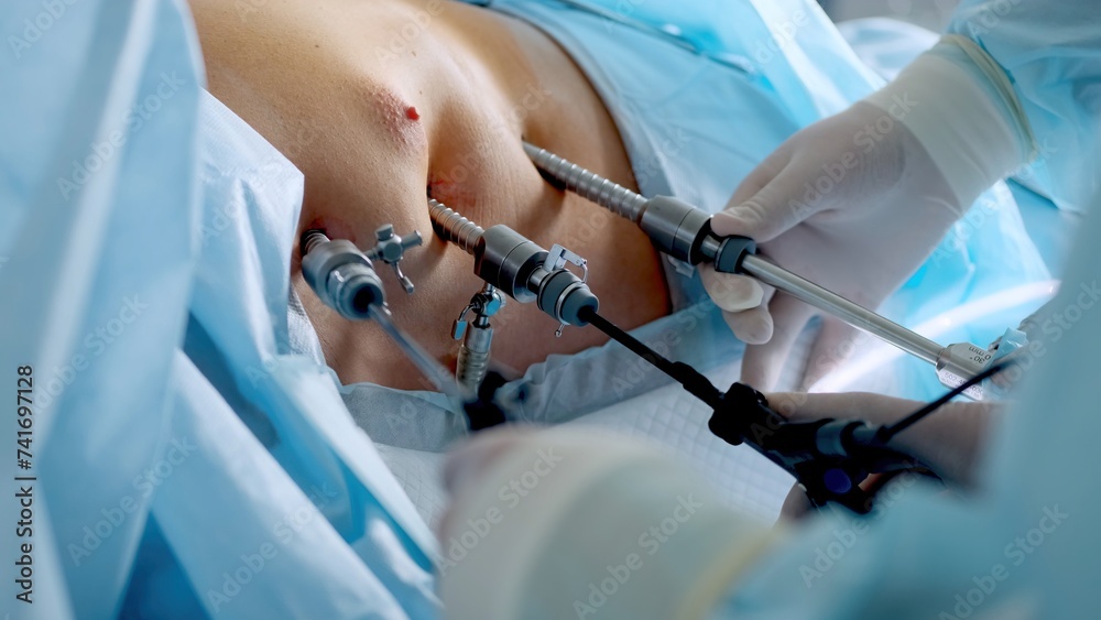 Operating room, team of surgeons performing laparoscopic intervention. Modern medicine, medical equipment in hospital. Laparoscope instruments. Doctors use endo-instruments and video cameras. - obrazy, fototapety, plakaty 