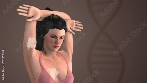 3d animation of the vitiligo skin disease photo