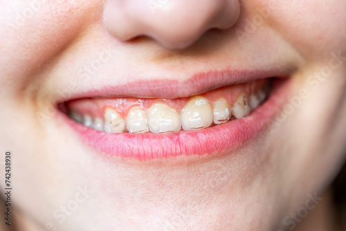 The girl has invisible braces on her teeth. Teeth straightening. 