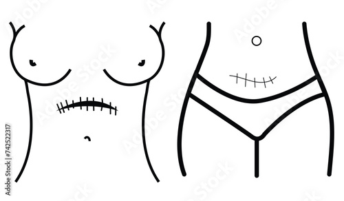 Transverse incision line icon. Abdominal incisions.
Scars line icon in vector, c-section scar illustration photo