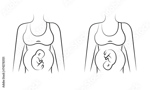 Caesarean section views icon line in vector, illustration of a pregnant woman 8 8 8
