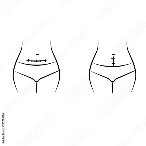 Stomach of a woman with a vertical and horizontal cesarean scar, type of c section vector illustration 7 8 9