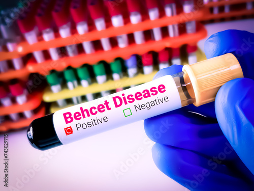 Blood sample for Behcet's disease (BD) test, HLA B51 (human leukocyte antigen). photo