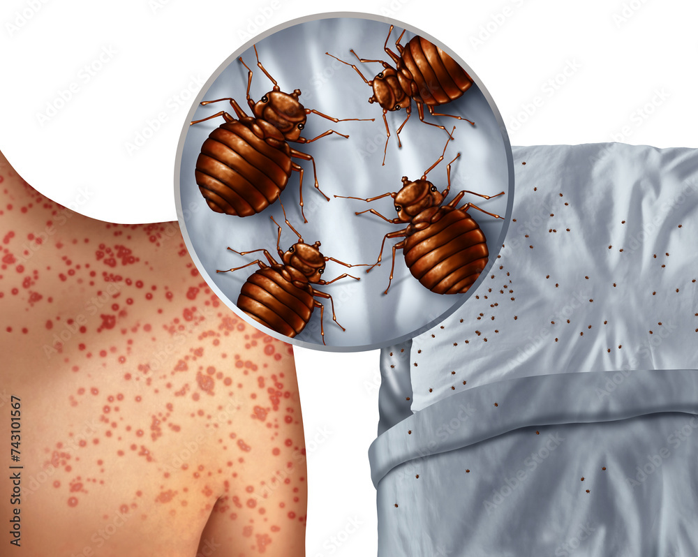 Bedbug bites rash or bedbug infestation concept as a magnification