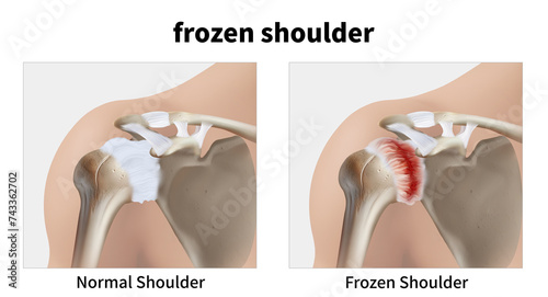 Medical illustration explaining frozen shoulder