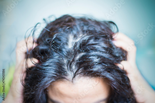 Dandruff and fungus on the scalp cause itching.