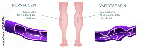 Varicose veins are bulging, enlarged veins or varicosities vector illustration. Hemorrhoids cause aching pain and discomfort or signal an underlying circulatory problem.
