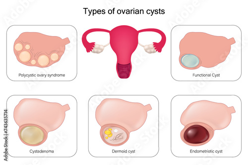 Types of ovarian cysts vector. Polycystic ovary syndrome, Cystadenoma, Dermoid cyst, Endometriotic cyst and Functional Cyst. photo