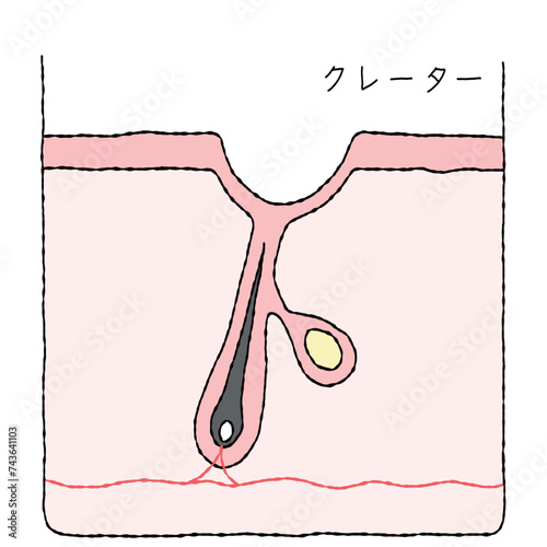 ニキビ跡の構造　