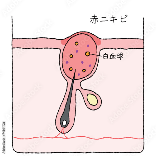 ニキビの構造　赤ニキビ